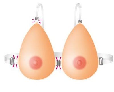     BREASTS SILICONE